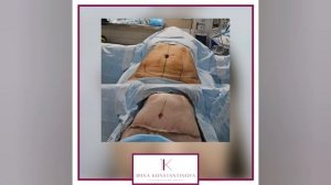 Классическая абдоминопластика с ушиванием диастаза и переносом пупка