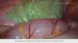 История пациента. Массивная опухоль в малом тазу с отсевами по брюшине. Рассказывает А.Л. Пылёв