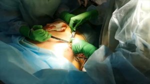Гинекомастия у мужчины. Операция по удалению увеличенных грудных желез.