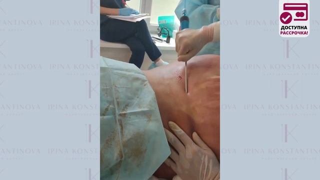 Липосакция боков и зоны 