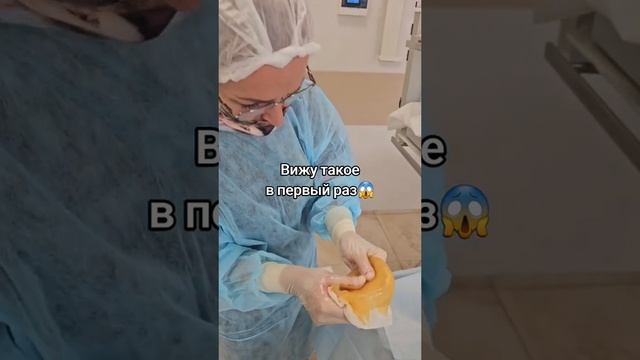 Извлеченный грудной имплант - вижу такое в первый раз! смотреть онлайн