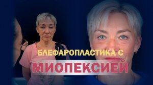 Подтяжка верхних и нижних век с миопексией - пластикой круговой мышцы глаза