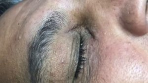 Old Eye Blackheads Part 2 by Dr.Lalit Kasana