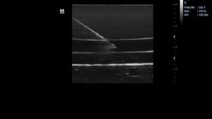 СОСУДИСТЫЙ ДОСТУП - УЛЬТРАЗВУКОВОЙ ФАНТОМ GELATEXA