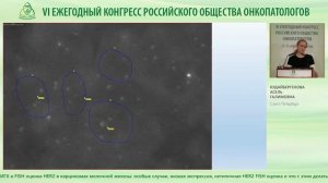 ИГХ и FISH оценка HER2 в карциномах молочной железы