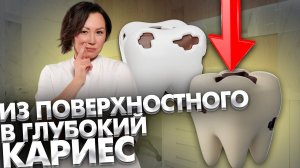 Как быстро поверхностный кариес без лечения может спрогрессировать до глубокого кариеса?