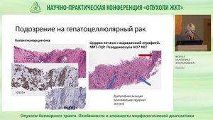 Опухоли билиарного тракта  Особенности и сложности морфологической диагностики