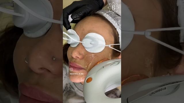 Ровный тон кожи без фильтров и макияжа🤩