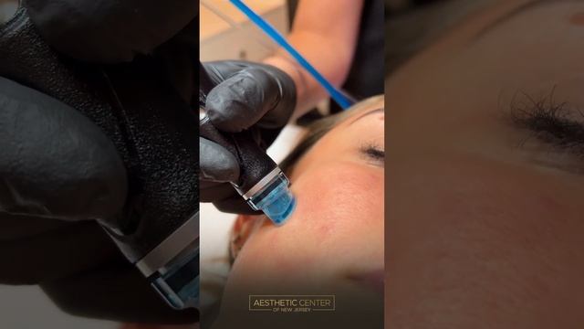 Acne HydraFacial with LED Phototherapy