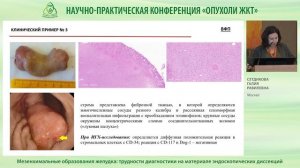 Мезенхимальные образования желудка – трудности диагностики на материале эндоскопических диссекций