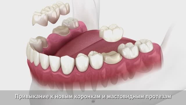 Несъемное протезирование зубов