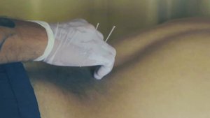 Acupuncture/акупунктура