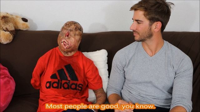 Thriving After Severe Burns (An Update with Zaid) смотреть онлайн