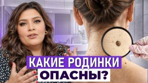 ТАКИЕ родинки могут быть УГРОЗОЙ! / Как распознать ОПАСНЫЕ изменения на коже?