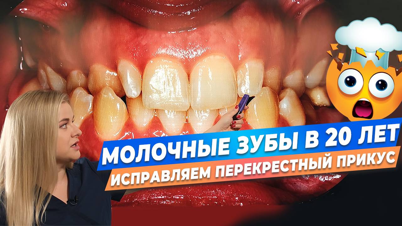 Ортодонтия. Лечение брекетами. Перекрестный прикус. Молочные зубы в 20 лет. Результат ДО/ПОСЛЕ.