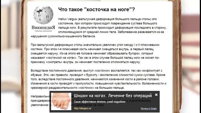 варус вальгус  острый приступ подагры