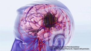 Выявление мерцательной аритмии с тонометрами Microlife