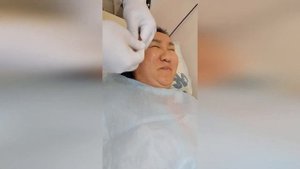 Иглорефлексотерапия при неврите лицевого нерва