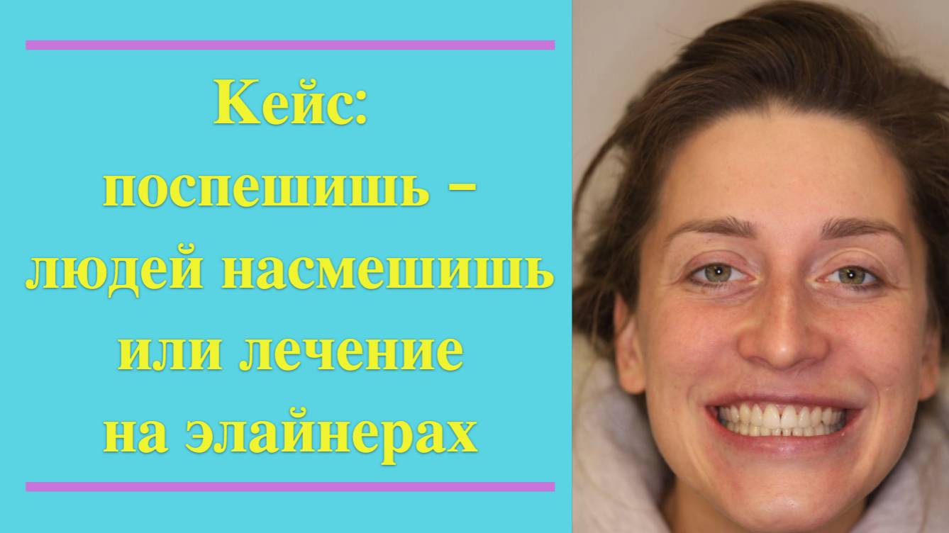 💎 Кейс: почему важно не пренебрегать ретейнерами после брекетов