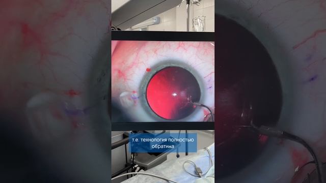 Миопия -12: Как мы вернули 100% зрение с помощью факичных линз! Чудо, ставшее реальностью.