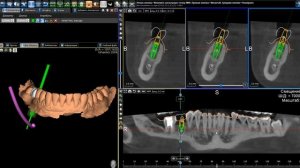 Расстановка имплантатов в программе 3Diagnosys