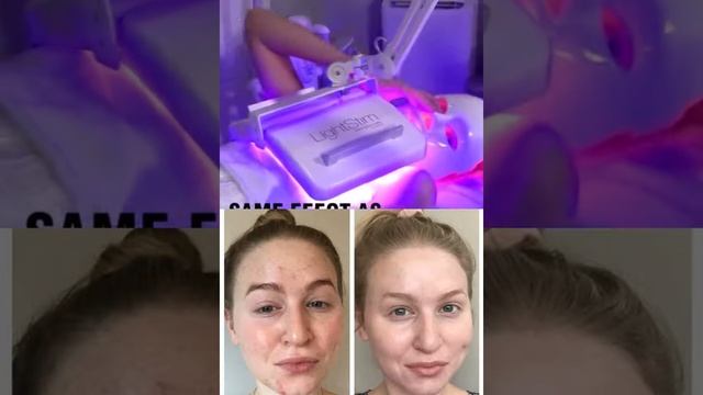 LED face mask | Acne face mask| LED light therapy