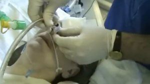 Ботулизм  клинический случай