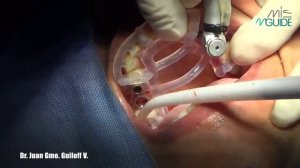 Установка имплантатов С1 с поверхностью В+ с помощью хирургического шаблона системы MGuide