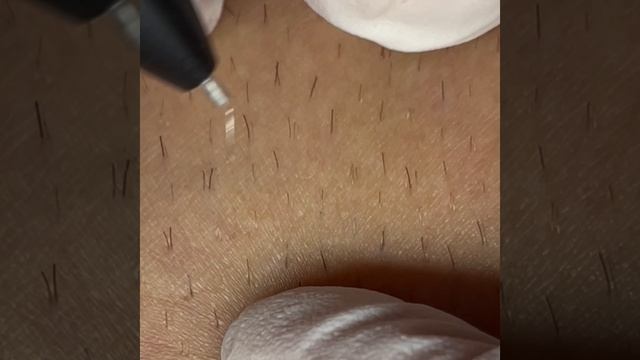 Электроэпиляция