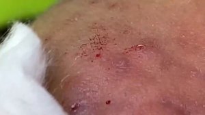 ACNE CLEANING RELAX - KINISH TV #45