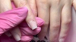 Работа с разросшимся гипонихием.