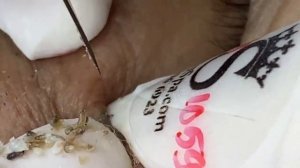 ACNE CLEANING RELAX - KINISH TV  #49