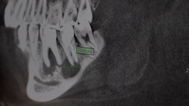 Компьютерная томография (КТ) в стоматологии: развод на деньги? | 3D диагностика челюсти и зубов