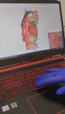 3D-сканирование полости рта