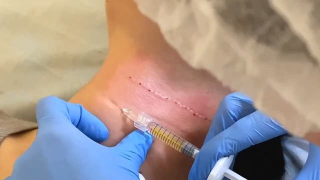 Коррекция колец Венеры на шее
Устранение морщин на шее филлером