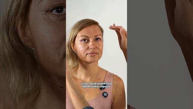 Ирина Леонидовна о результате периорбитопластики через 1 год