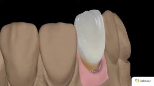 Протезирование на абатментах BEGO Semados® Sub Tec Universal с шестигранником