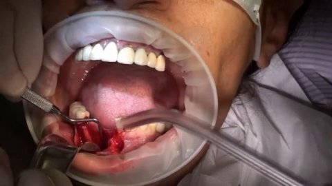 Костна аугментация с Bond Bone.