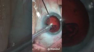 Удаление катаракты с имплантацией ИОЛ