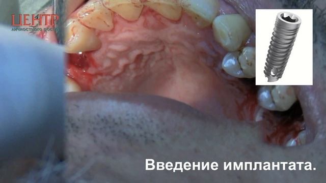 Видео для вебинара Одномоментная имплантация
