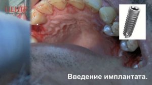 Видео для вебинара Одномоментная имплантация