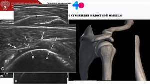 «Подводные камни» и ошибки при УЗ сканировании ротаторной манжеты в норме