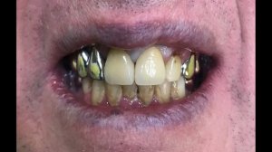 Duceram Kiss нанесение керамики анатомия зубов лайфхаки стоматология карвинг зубные техники зубы