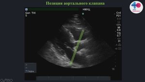 HOW TO - мониторинг волемического статуса, легочная артерия