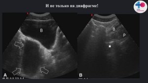 eFAST протокол - ошибки и подводные камни метода