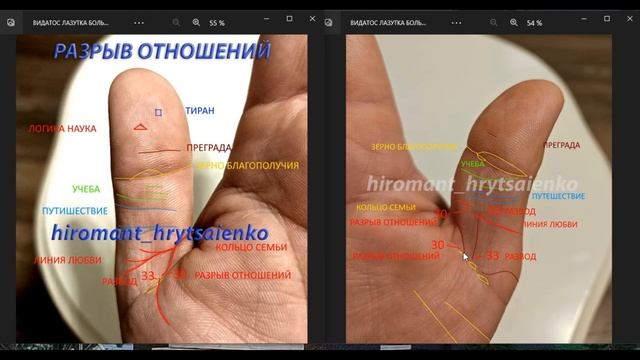 РАЗРЫВ ОТНОШЕНИЙ НА БОЛЬШОМ ПАЛЬЦЕ