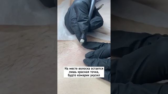 Как проходит электроэпиляция?⚡️Читай ниже