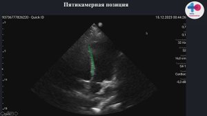 HOW TO  Мониторинг волемического статуса - вариабельность VTI на выносящем тракте левого желудочка