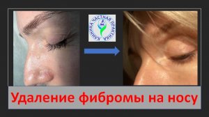 Удаление фибромы на носу