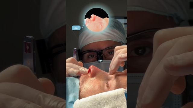 Результат мужской риносептопластики на операционном столе 👃🏼